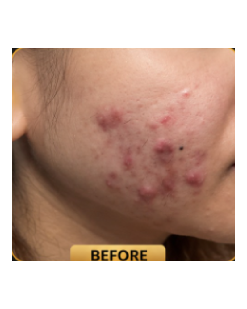 Acne Treatment — Before