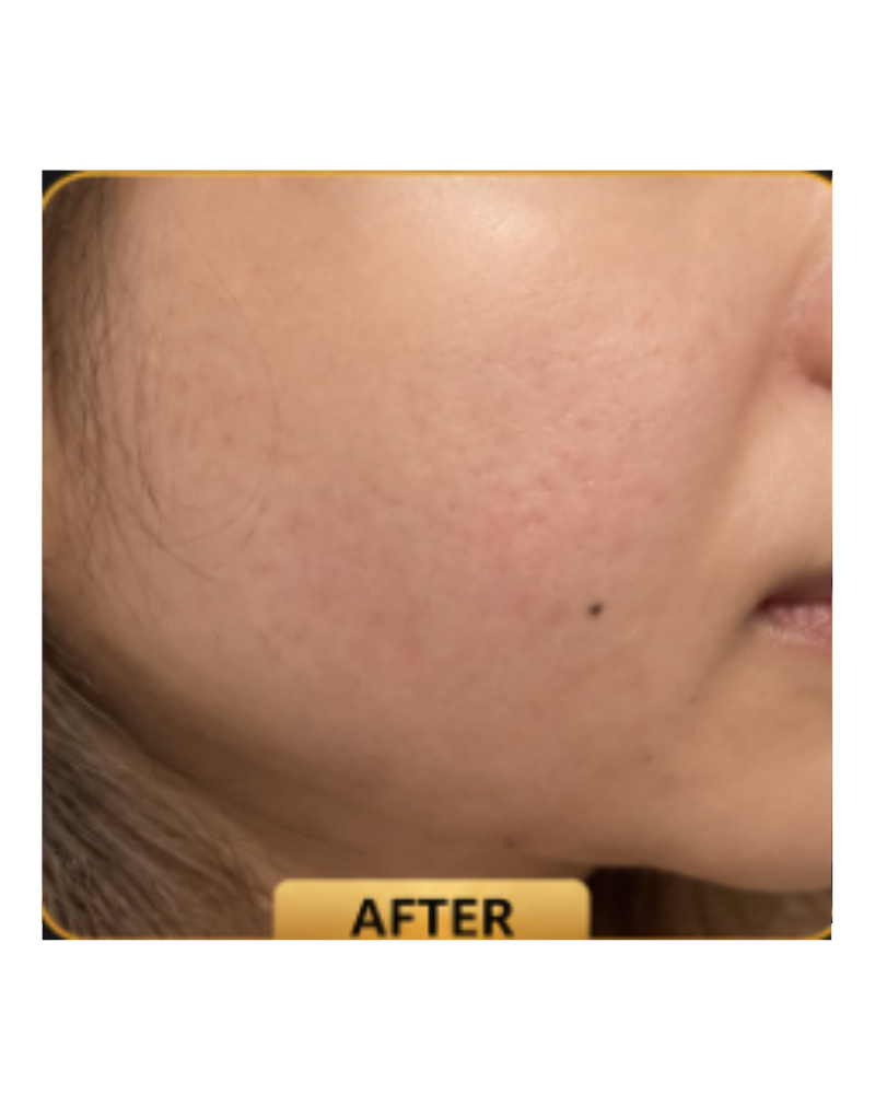 Acne Treatment — After