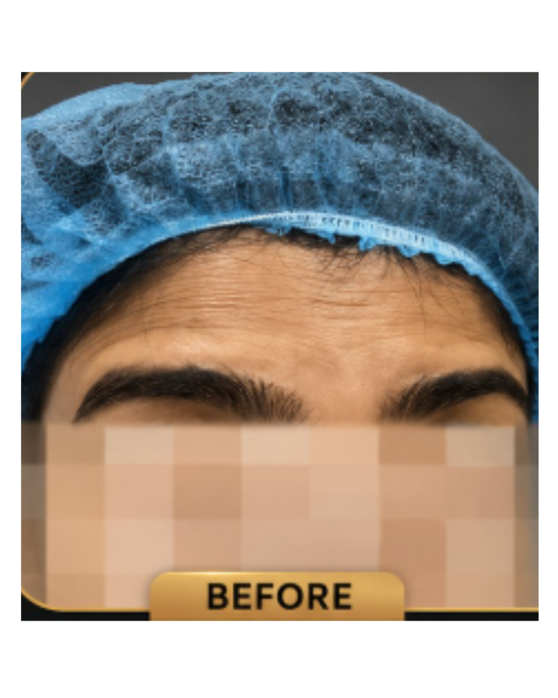 Fine lines and forehead wrinkles — Before