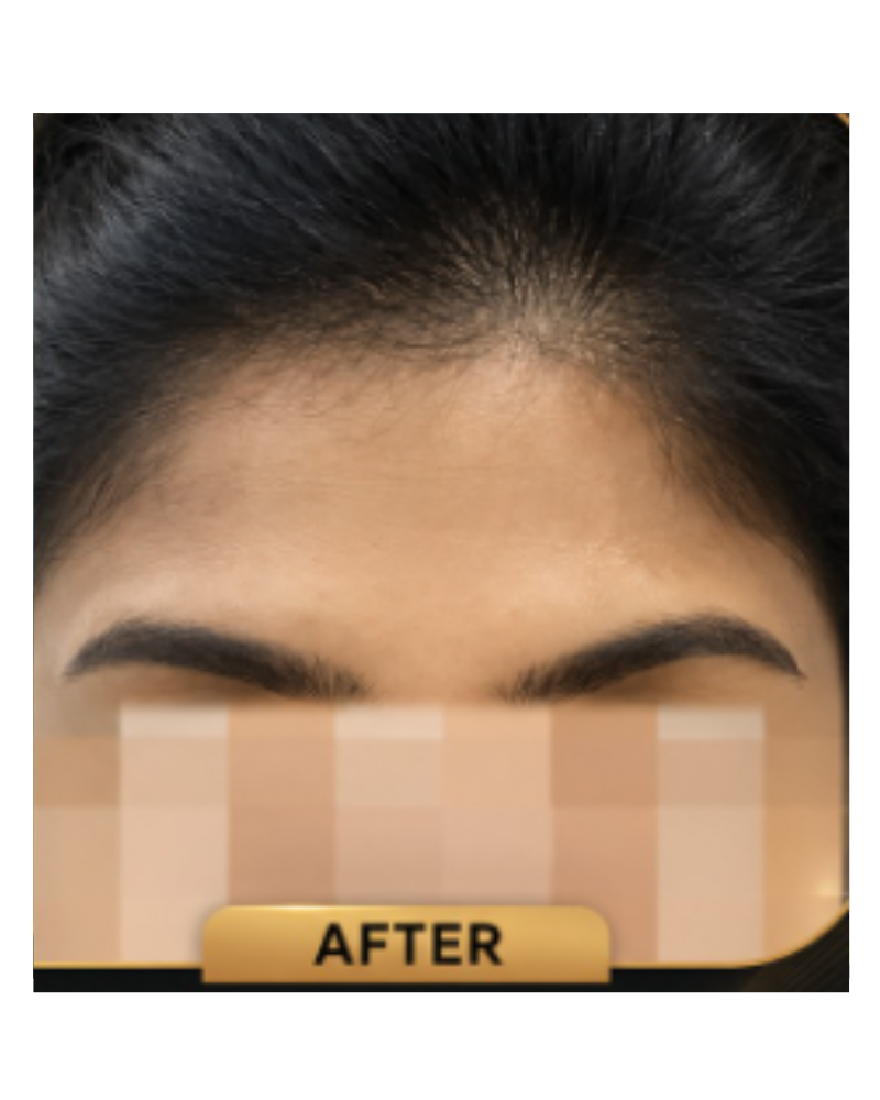 Fine lines and forehead wrinkles — After
